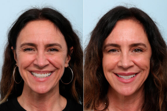Xeomin / Botox® Cosmetic before and after photos in Houston, TX, Patient 59236