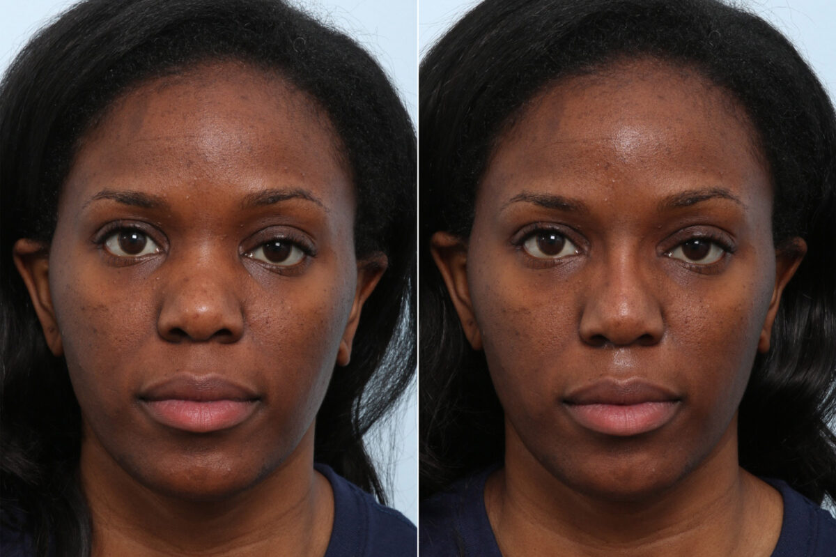 Non-Surgical Rhinoplasty before and after photos in Houston, TX, Patient 59262