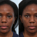 Non-Surgical Rhinoplasty before and after photos in Houston, TX, Patient 59262