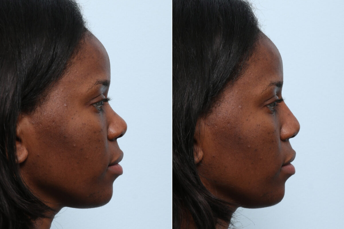 Non-Surgical Rhinoplasty before and after photos in Houston, TX, Patient 59262