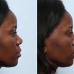 Non-Surgical Rhinoplasty before and after photos in Houston, TX, Patient 59262