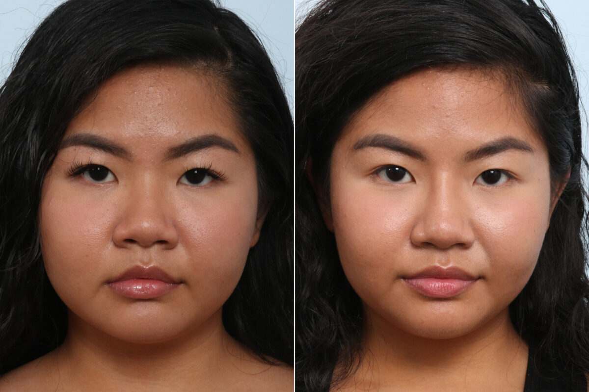 Non-Surgical Rhinoplasty before and after photos in Houston, TX, Patient 59269