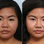 Non-Surgical Rhinoplasty before and after photos in Houston, TX, Patient 59269