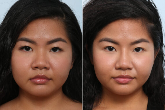 Non-Surgical Rhinoplasty before and after photos in Houston, TX, Patient 59269