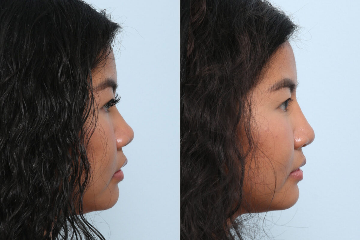 Non-Surgical Rhinoplasty before and after photos in Houston, TX, Patient 59269
