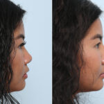 Non-Surgical Rhinoplasty before and after photos in Houston, TX, Patient 59269