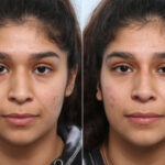 Non-Surgical Rhinoplasty before and after photos in Houston, TX, Patient 59270