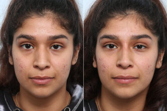 Non-Surgical Rhinoplasty before and after photos in Houston, TX, Patient 59270