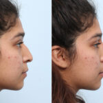 Non-Surgical Rhinoplasty before and after photos in Houston, TX, Patient 59270