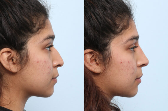 Non-Surgical Rhinoplasty before and after photos in Houston, TX, Patient 59270