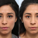 Non-Surgical Rhinoplasty before and after photos in Houston, TX, Patient 59304