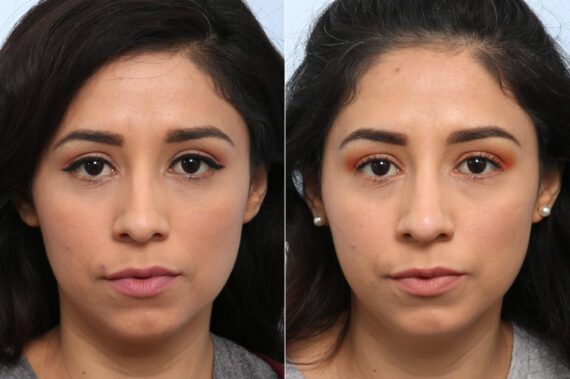 Non-Surgical Rhinoplasty before and after photos in Houston, TX, Patient 59304