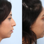 Non-Surgical Rhinoplasty before and after photos in Houston, TX, Patient 59304