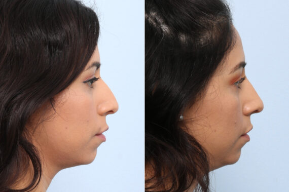 Non-Surgical Rhinoplasty before and after photos in Houston, TX, Patient 59304