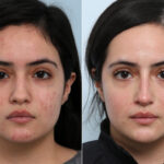 Non-Surgical Rhinoplasty before and after photos in Houston, TX, Patient 59311