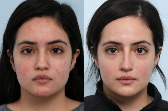 Non-Surgical Rhinoplasty before and after photos in Houston, TX, Patient 59311