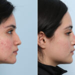 Non-Surgical Rhinoplasty before and after photos in Houston, TX, Patient 59311