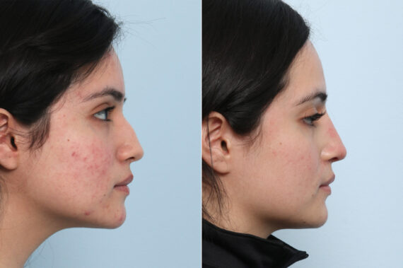Non-Surgical Rhinoplasty before and after photos in Houston, TX, Patient 59311