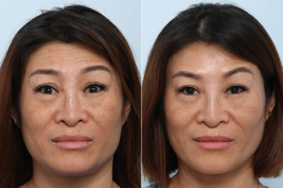 Xeomin / Botox® Cosmetic before and after photos in Houston, TX, Patient 59871