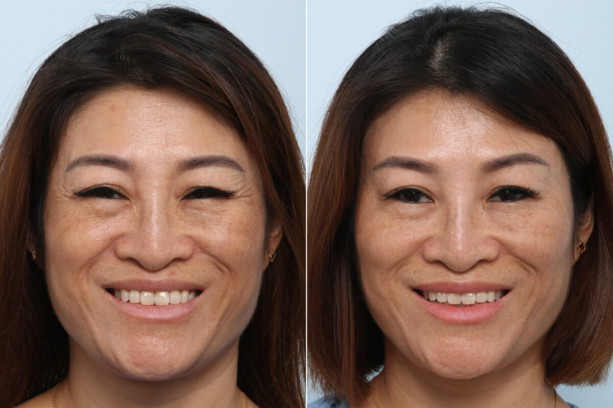 Xeomin / Botox® Cosmetic before and after photos in Houston, TX, Patient 59871