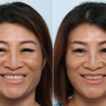 Botox® Cosmetic before and after photos in Houston, TX, Patient 59871