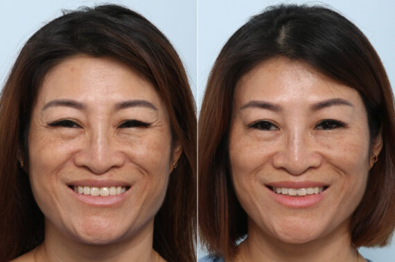 Xeomin / Botox® Cosmetic before and after photos in Houston, TX, Patient 59871