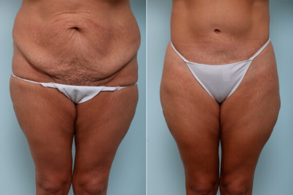 Body Lift before and after photos in Houston, TX, Patient 59897