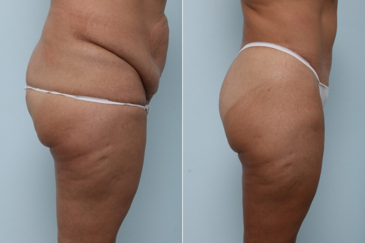 Body Lift before and after photos in Houston, TX, Patient 59897