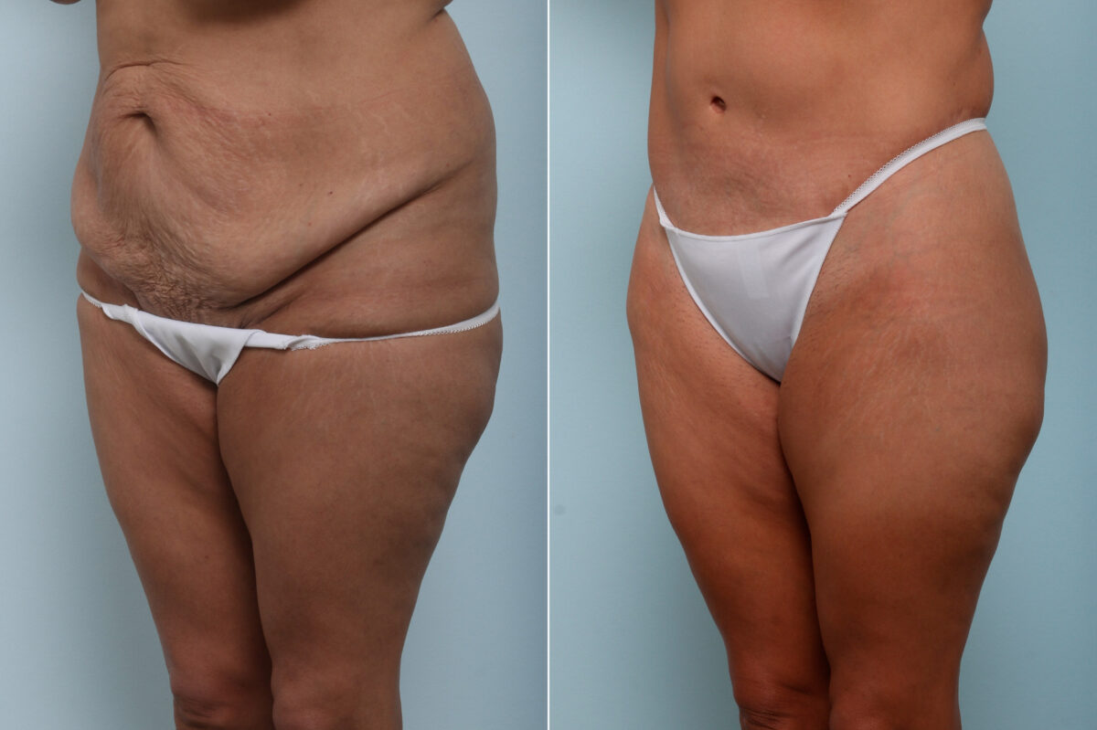 Body Lift before and after photos in Houston, TX, Patient 59897