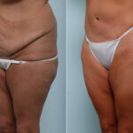 Body Lift before and after photos in Houston, TX, Patient 59897