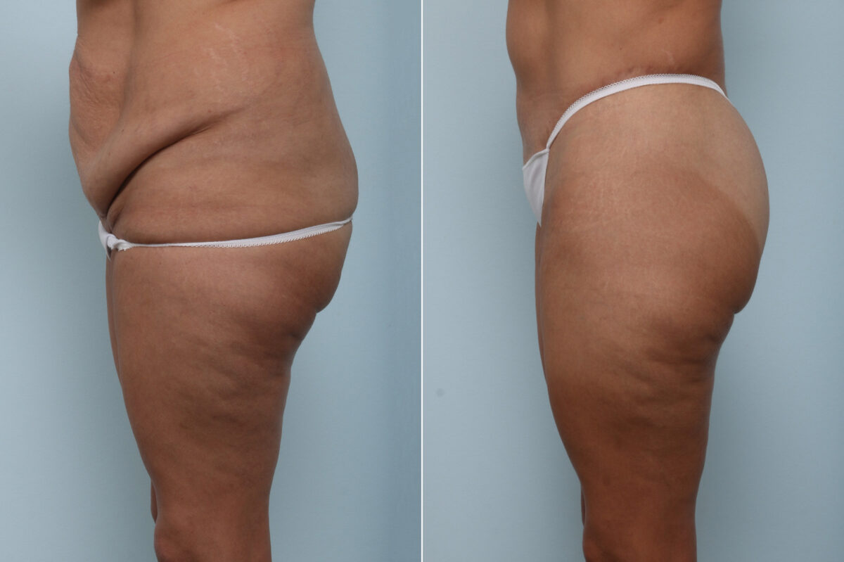 Body Lift before and after photos in Houston, TX, Patient 59897