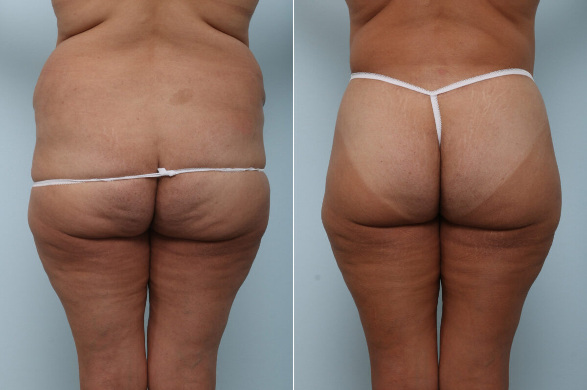 Body Lift before and after photos in Houston, TX, Patient 59897