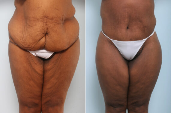 Body Lift before and after photos in Houston, TX, Patient 59898