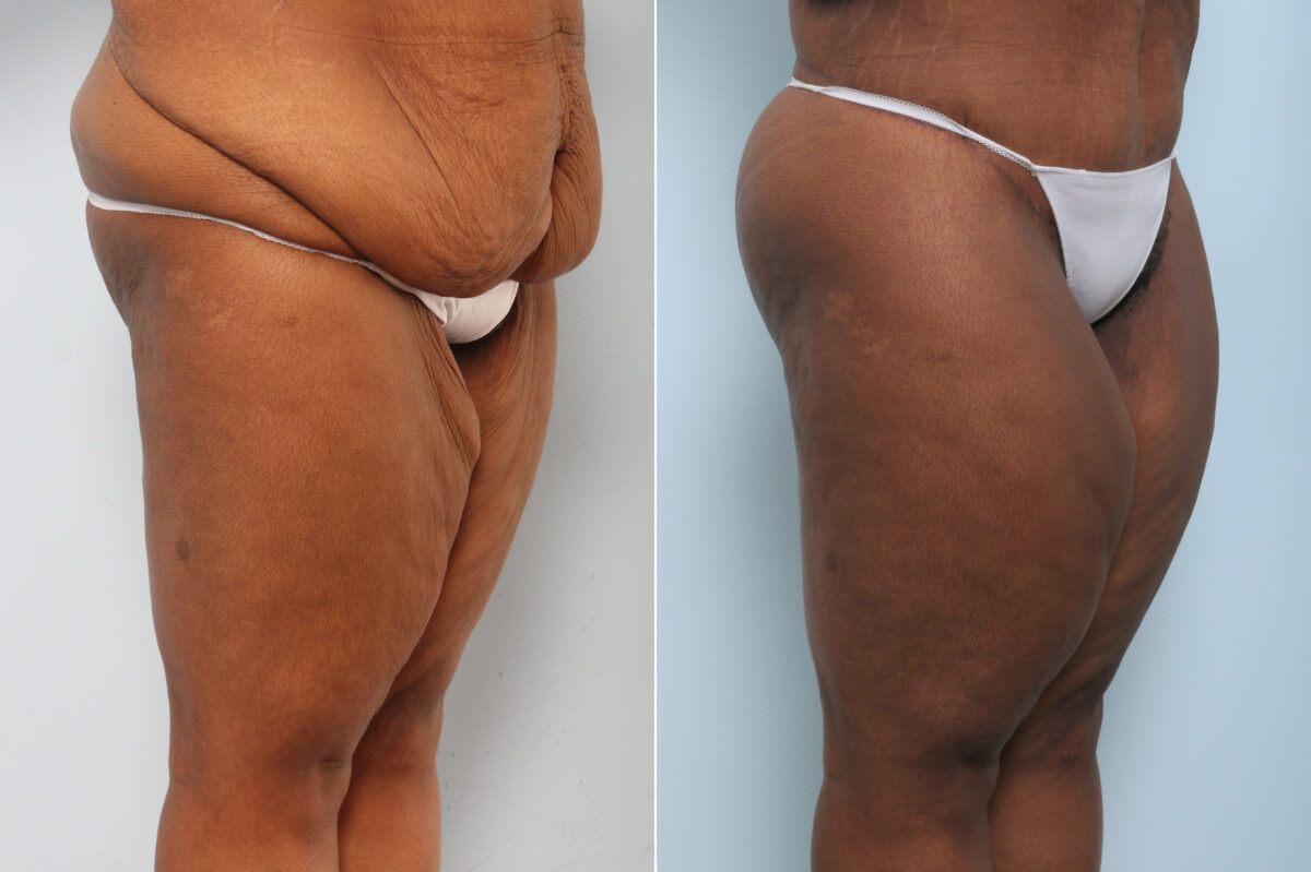 Body Lift before and after photos in Houston, TX, Patient 59898