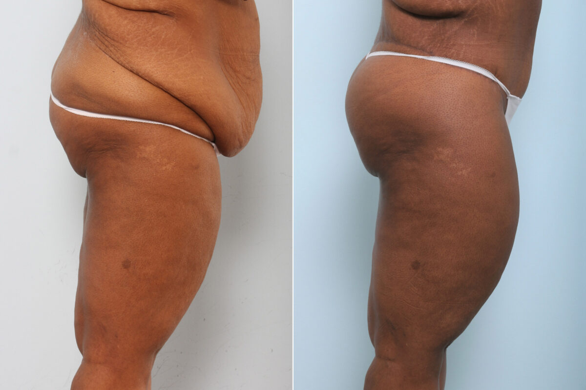 Body Lift before and after photos in Houston, TX, Patient 59898