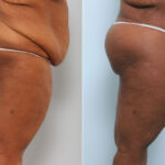 Body Lift before and after photos in Houston, TX, Patient 59898