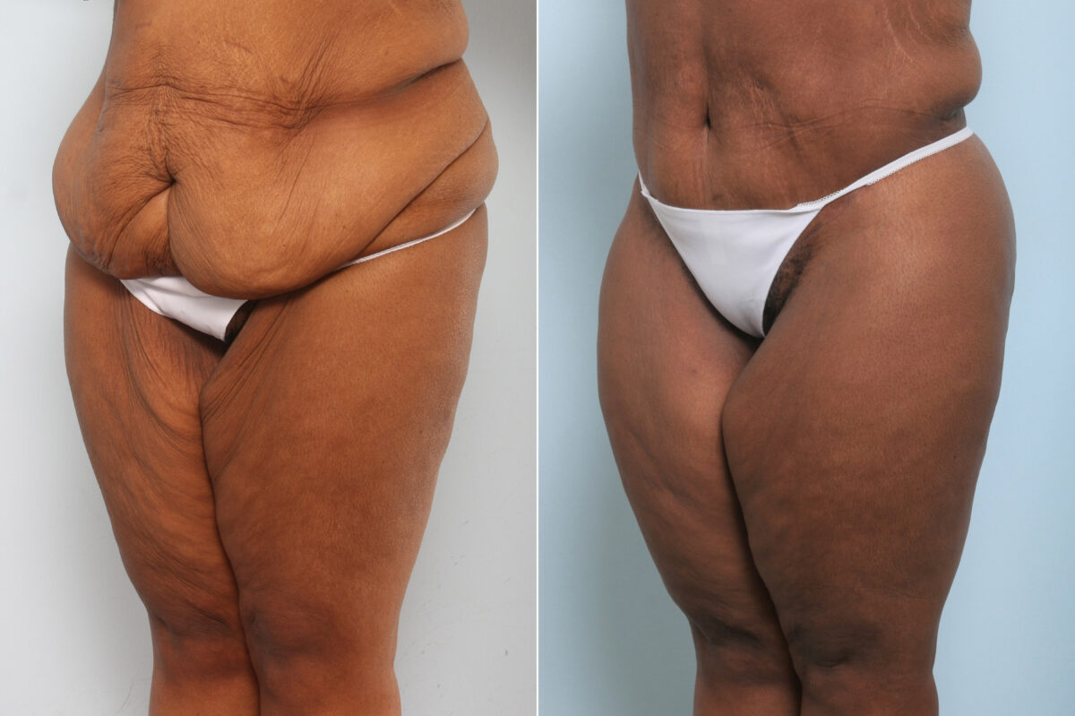 Body Lift before and after photos in Houston, TX, Patient 59898