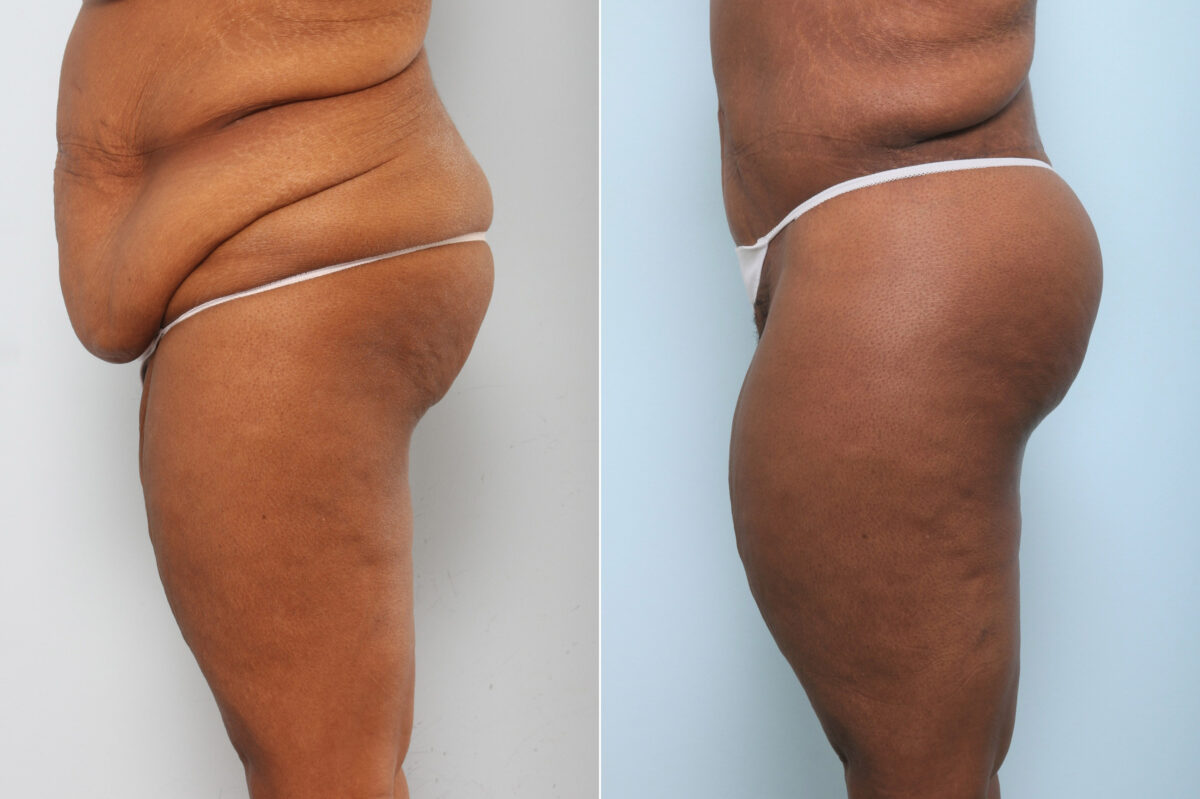 Body Lift before and after photos in Houston, TX, Patient 59898