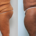 Body Lift before and after photos in Houston, TX, Patient 59898