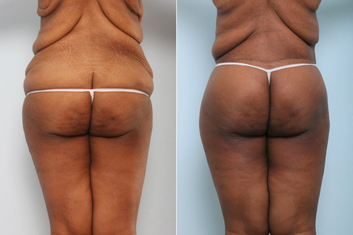 Body Lift before and after photos in Houston, TX, Patient 59898