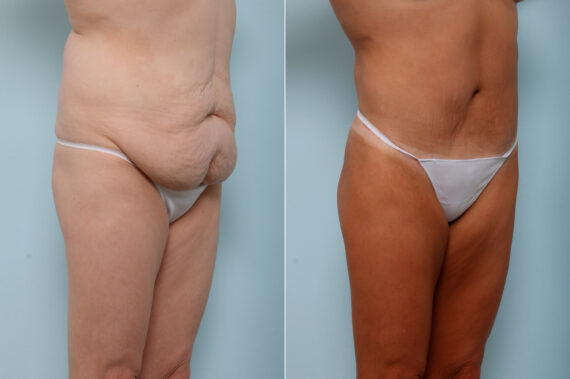 Body Lift before and after photos in Houston, TX, Patient 59937