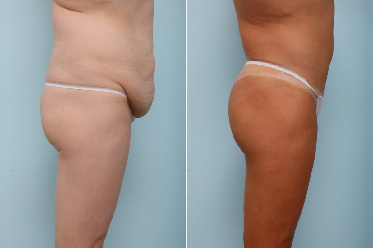 Body Lift before and after photos in Houston, TX, Patient 59937