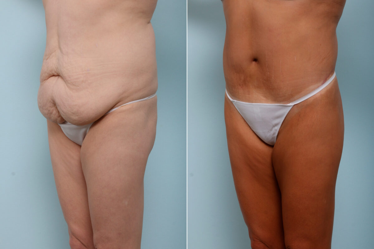 Body Lift before and after photos in Houston, TX, Patient 59937