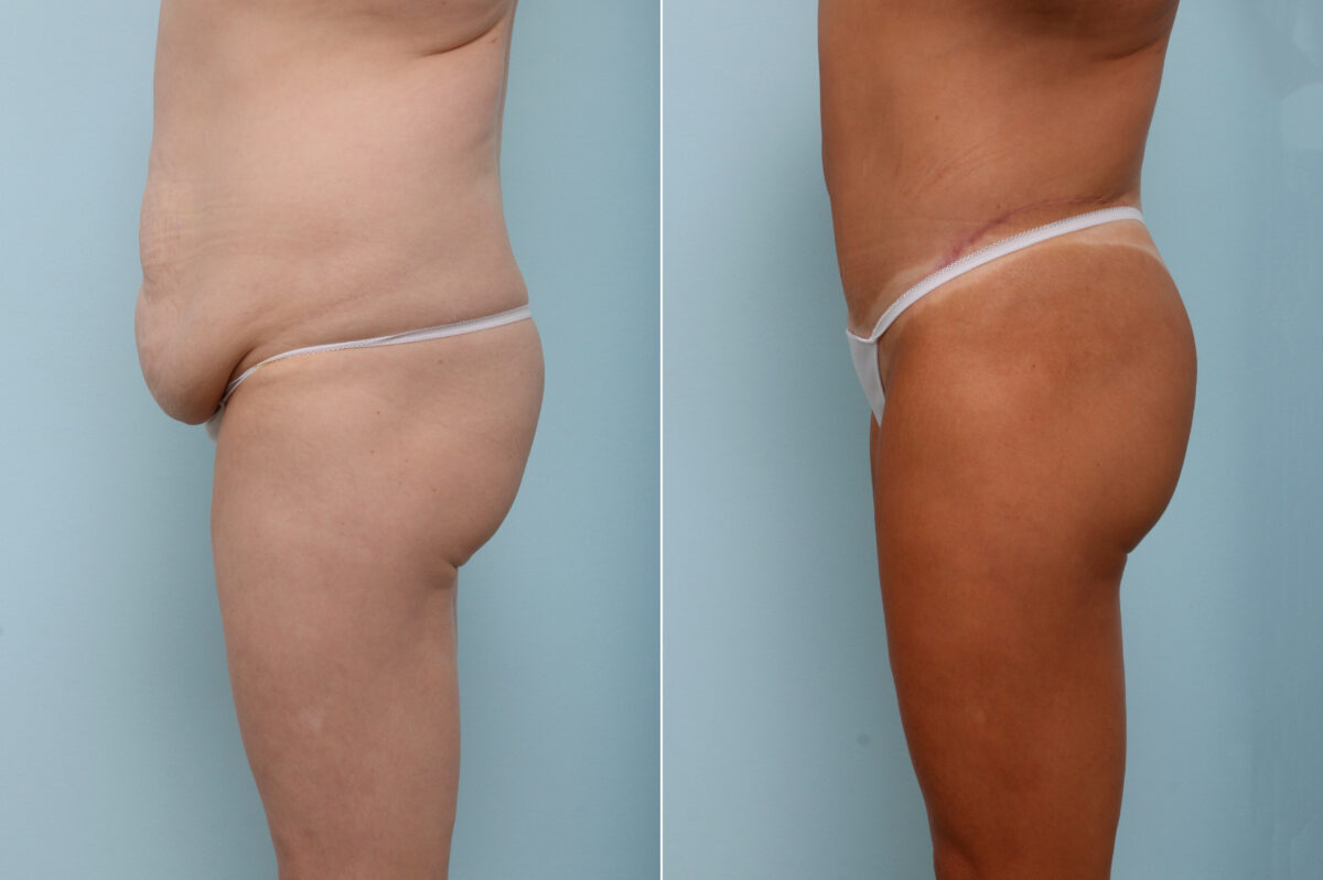 Body Lift before and after photos in Houston, TX, Patient 59937