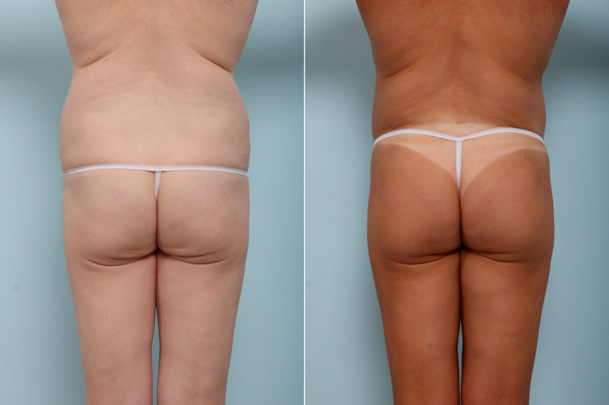 Body Lift before and after photos in Houston, TX, Patient 59937