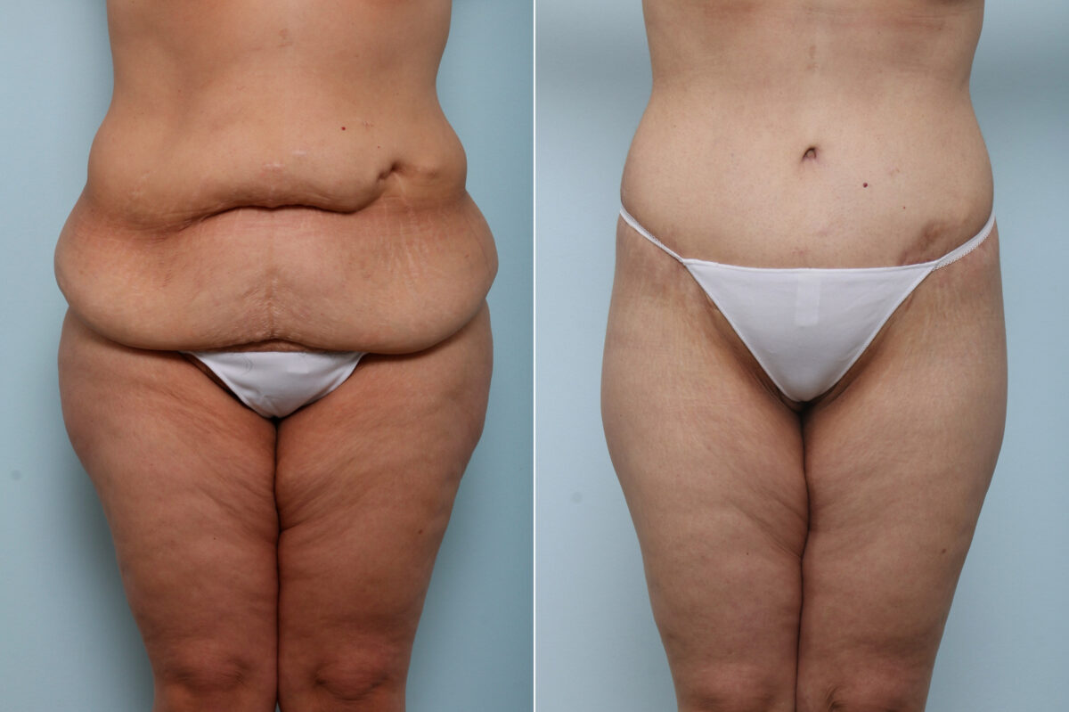 Body Lift before and after photos in Houston, TX, Patient 59956