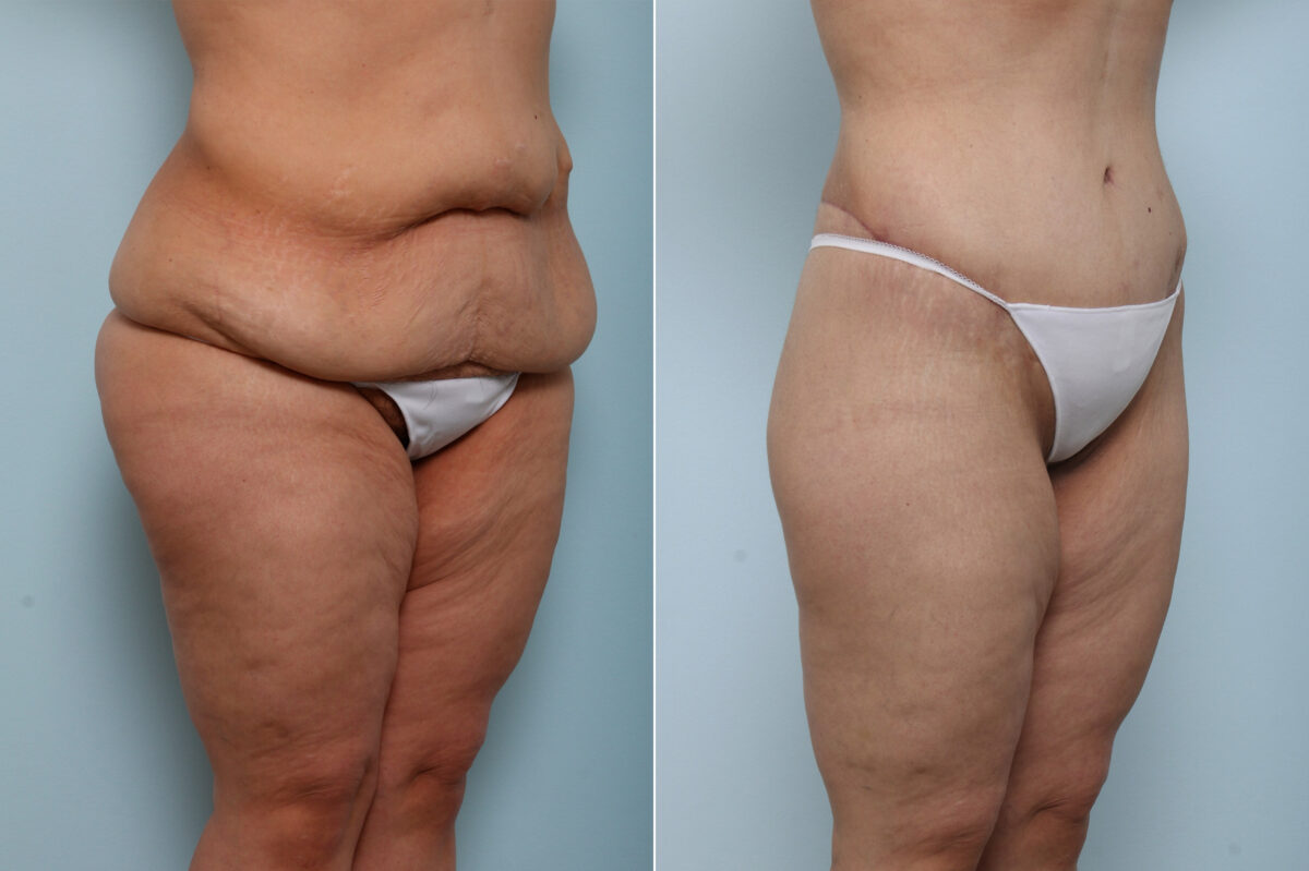 Body Lift before and after photos in Houston, TX, Patient 59956