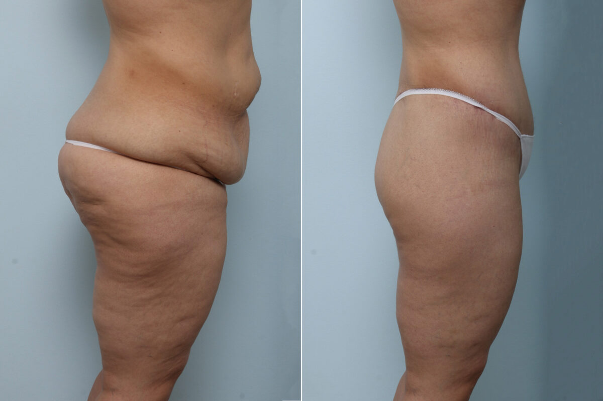 Body Lift before and after photos in Houston, TX, Patient 59956