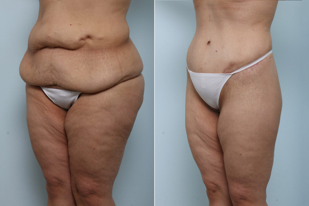 Body Lift before and after photos in Houston, TX, Patient 59956