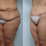 Body Lift before and after photos in Houston, TX, Patient 59956